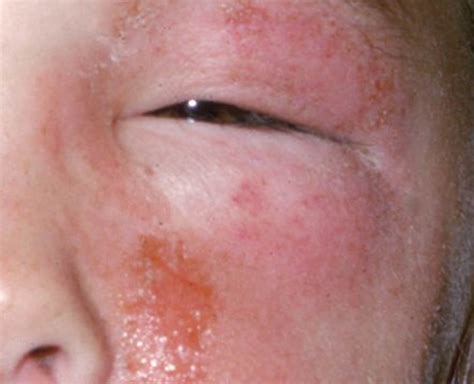 Poison Ivy Rash Symptoms And Causes With Images Poiso