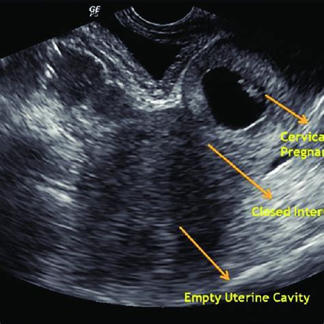 Transvaginal Ultrasound Ovary My Xxx Hot Girl