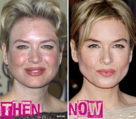 Renee Zellweger Plastic Surgery Before After Photos Celebrity Plastic Surgery Plastic