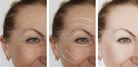 Female Wrinkles Removal Before And After Procedure Results Regeneration