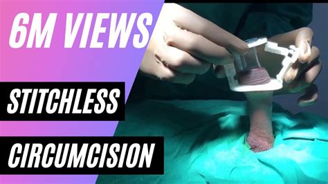 Adult Circumcision Aliskamp Zsr Stapler By Dr Rizwan Khan Pune Phimosis Foreskin Treatment