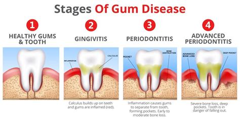 How To Treat Periodontal Disease Gum Disease