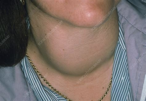 Swelling Of Neck Due To Thyrotoxic Goitre Stock Image M1650153