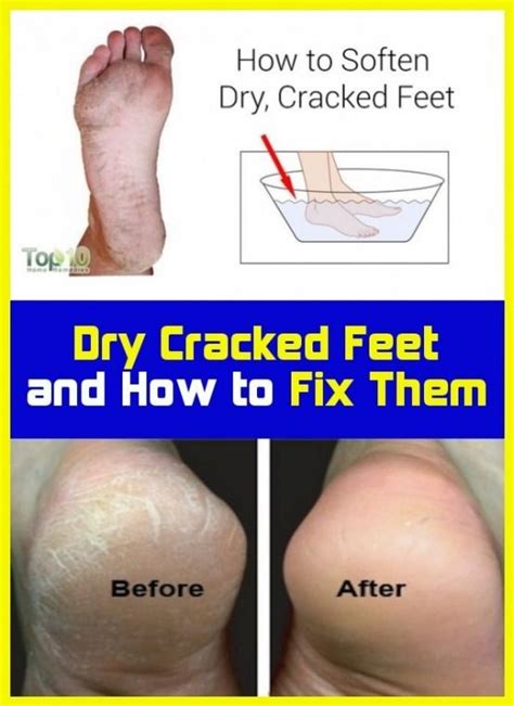 Dry Cracked Feet And How To Get Them Right In 2020 Cracked Feet Dry