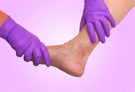 Your Guide To Venous Insufficiency And How To Prevent It Usa Today