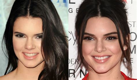 Kendall Jenner Before Plastic Surgery Before And After