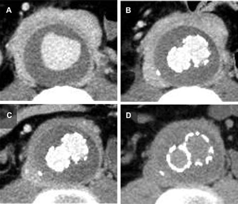 Follow Up Computed Tomography Ct Of Aorta A Preoperative Ct Scan