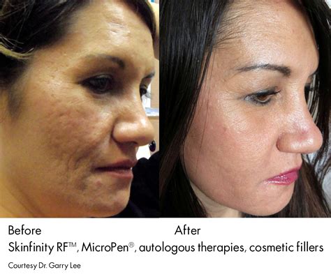Microneedling With Prp For Acne Scars Before And After Babyacnearticles