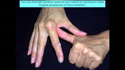 Pictures Of Warts On Hands Youtube