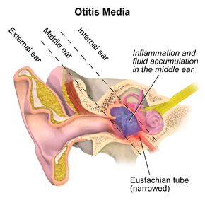 Otitis Causes Symptoms Diagnosis And Treatment Expert Chikitsa