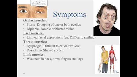 Is it causal or coincidental? Myasthenia Gravis - YouTube