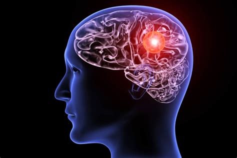 New artificial intelligence tool helps diagnose brain aneurysms - Tech ...