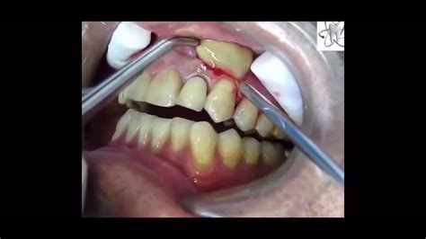 Upper Buccal Abscess Incision Drainage Youtube
