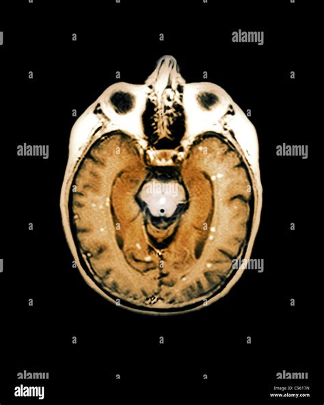Secondary Brain Cancer Mri Scan Stock Photo Alamy