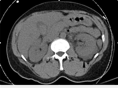 Ct Abdomen And Pelvis Without Contrast Showing Fluid Surrounding Both