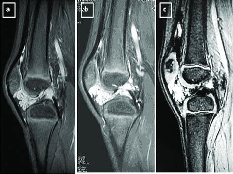 Sagittal Mri Images Of The Right Knee A Proton Density