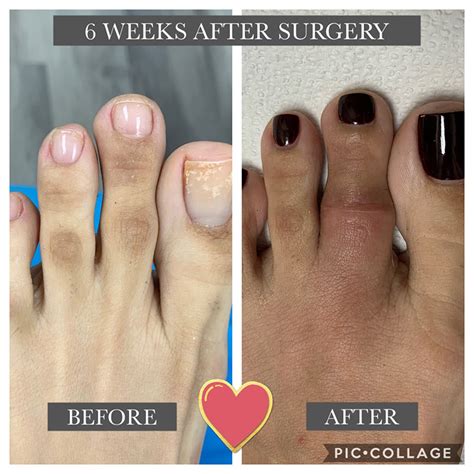 Cosmetic Foot Surgery Vs Corrective Foot Surgery Jaws Podiatry