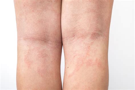 Do You Suffer From Psoriasis Skin Dipt