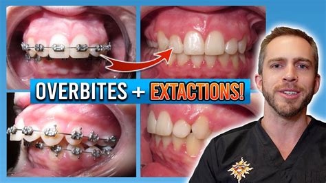 Braces Overbite Treatment Before After Youtube