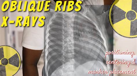 Oblique Ribs X Ray Positioning Centering And Marker Tips Ask The