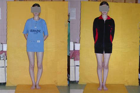 Operative Correction Of Bowed Legs Or Knock Knees Photos Of Patients