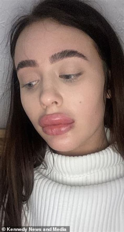 Ladys Lips Triple In Size After Botched Lip Filler Treatment Photos