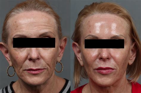 Dermal Fillers Before And After Photos Patient 637 Louisville Ky Calospa® Rejuvenation Center