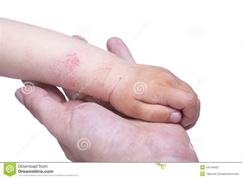 Eczema On The Kid S Hand Stock Photo Image Of Closeup 54144562