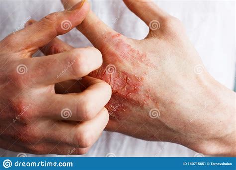 Man Scratch Oneself Dry Flaky Skin On Hand With Psoriasis Vulgaris