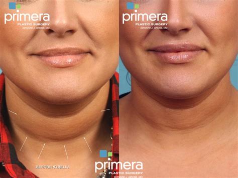 Kybella® Before And After Photos Patient 481 Orlando Florida Primera