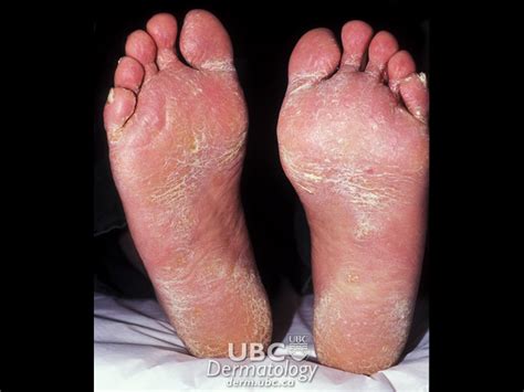 Skin Rash Fungal Infections Fungus Mayra Flores Images