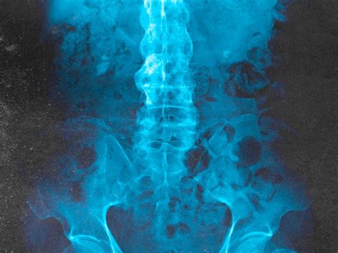 Bamboo Spine X Rays Symptoms Cause And Treatment