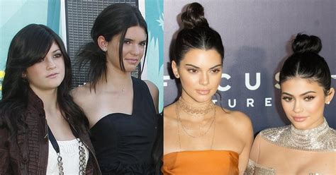 Has Kendall Jenner Had Plastic Surgery Face Before And After