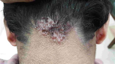Can Acne Keloidalis Cause Hair Loss What You Need To Know