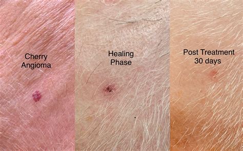 Skin Classic Skin Irregularity Treatment Allure Spa And Skin Health