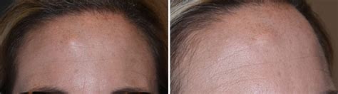 Plastic Surgery Case Study Forehead Osteoma Removal With A Frontal