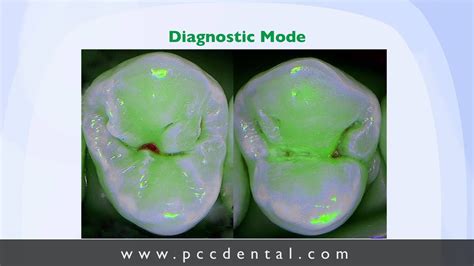 Ask Gordon Caries Detector For Occlusal Caries Youtube