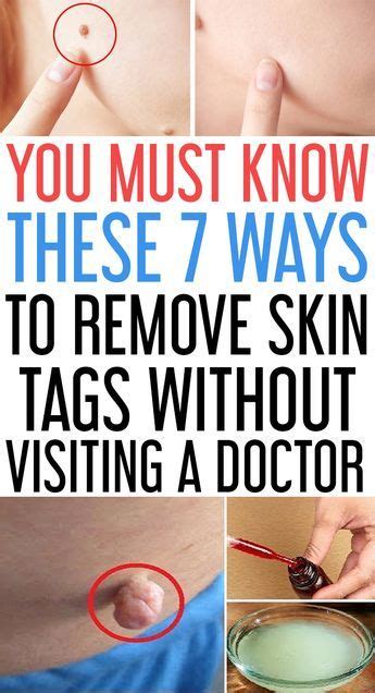 go for it 7 easy ways to remove skin tags without visiting a doctor skin tag removal skin