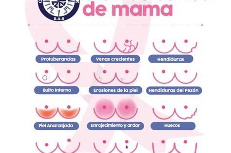 Se Ales De Alerta En El C Ncer De Mama Onc Logos Del Occidente S A S