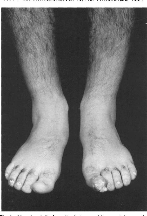 Figure From An Adult With Juvenile Hyaline Fibromatosis Of The Foot