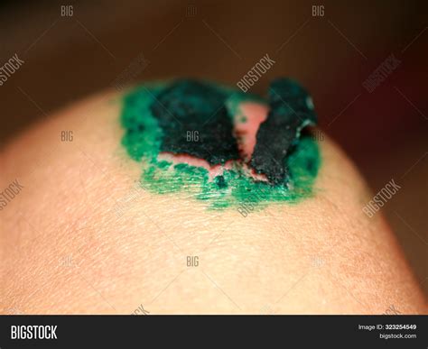 Healing Wound On Knee Image And Photo Free Trial Bigstock