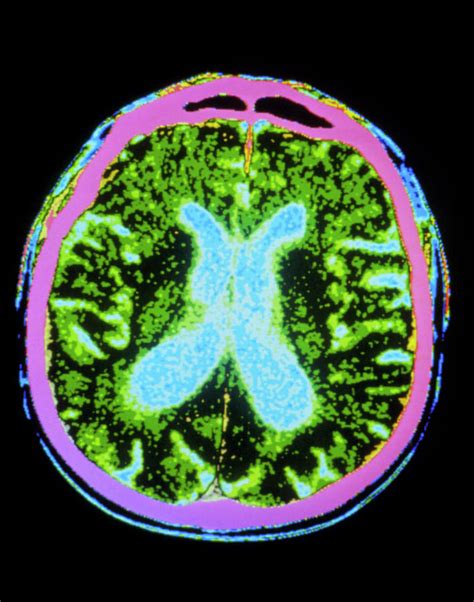 In idiopathic parkinson's disease, progression tends to be slow and variable. Coloured Ct Scan Of A Brain In Parkinson's Disease Photograph by Gjlp/science Photo Library