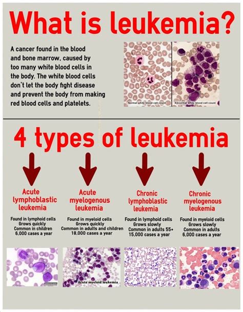 What Is Leukemia A Cancer Found In The Blood And Bone Marrow Caused By