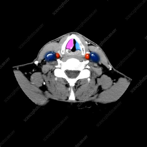 Paralyzed Vocal Cord Ct Stock Image C0075844 Science Photo Library