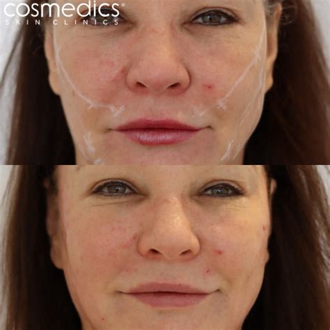 Thread Lift Facelift Treatments Cosmedics Skin Clinics