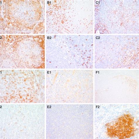 Immunohistochemical Markers In Rapidly Transforming And Nontransforming