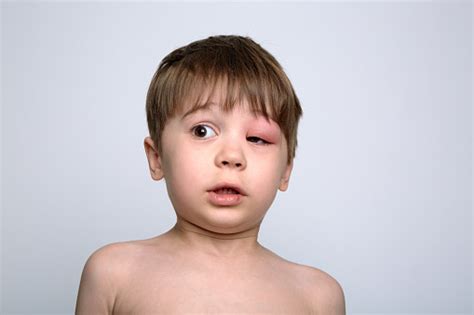 Child With Red Swollen Eye From Insect Bite Quincke Edema Portrait Of