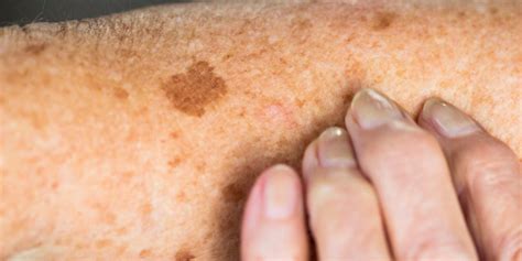 Skin Sunspots Aka Age Spots Causes Prevention And How To Get Rid