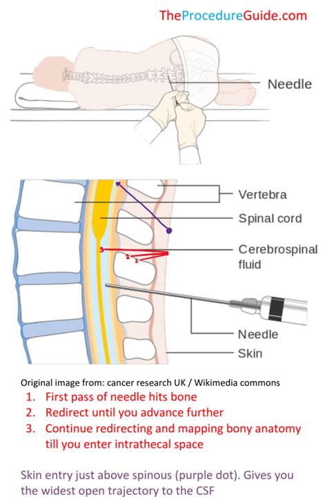 Lumbar Puncture Spinal Tap Technique And Overview The Procedure Guide