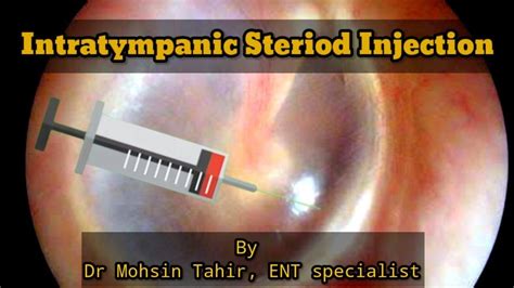 Intratympanic Steroid Injection Youtube